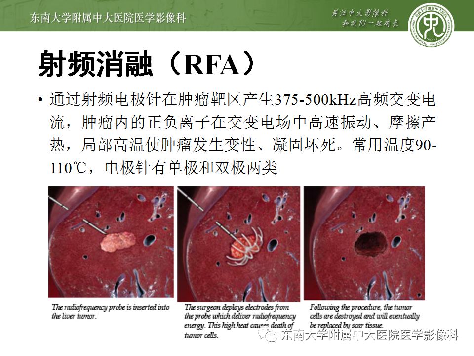 【病例】肝癌介入术后消融区凝固性坏死1例CT影像表现