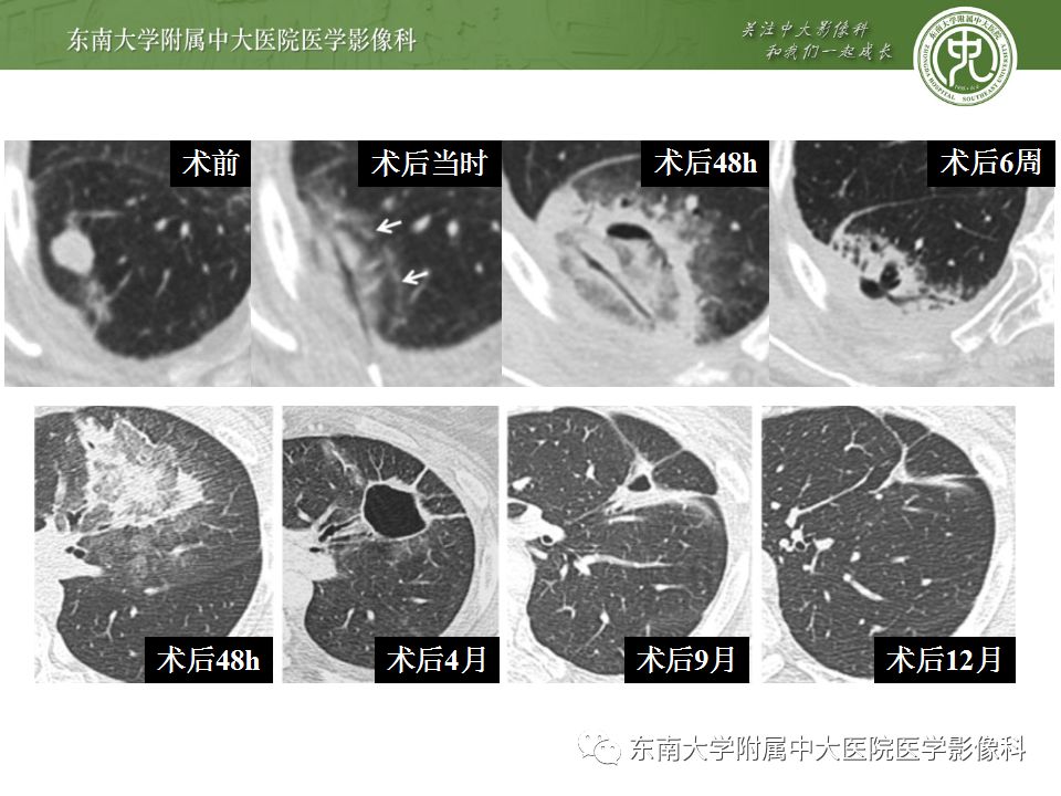 【病例】肝癌介入术后消融区凝固性坏死1例CT影像表现