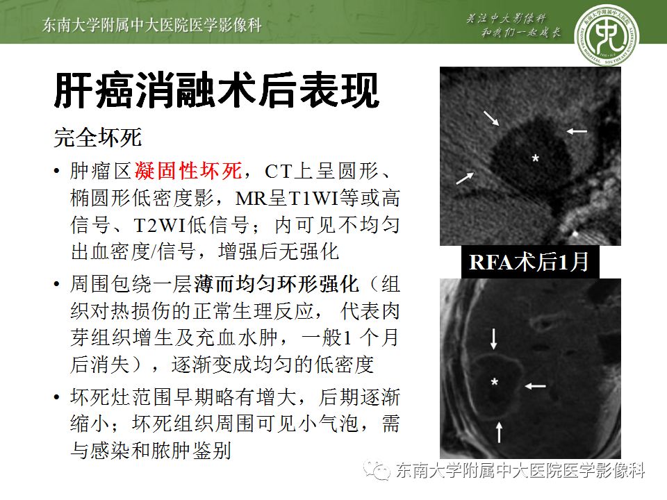 【病例】肝癌介入术后消融区凝固性坏死1例CT影像表现
