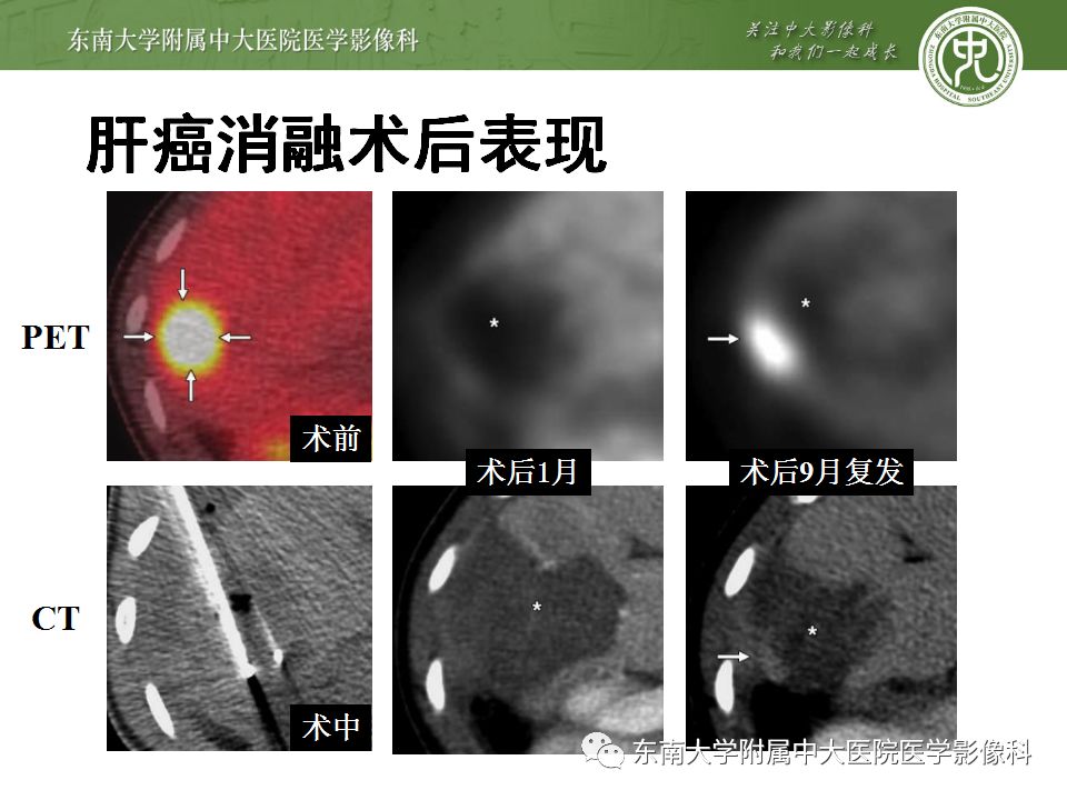 【病例】肝癌介入术后消融区凝固性坏死1例CT影像表现