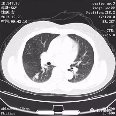 【病例】肺动静脉瘘1例CT影像表现 【病例】肺动静脉瘘1例CT影像表现