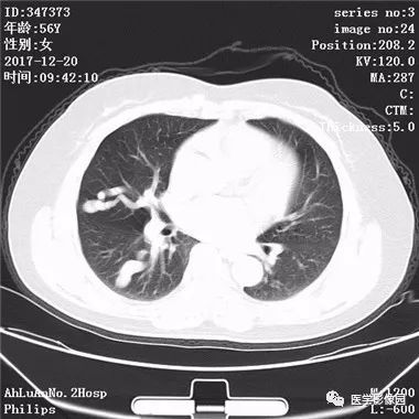 【病例】肺动静脉瘘1例CT影像表现 【病例】肺动静脉瘘1例CT影像表现