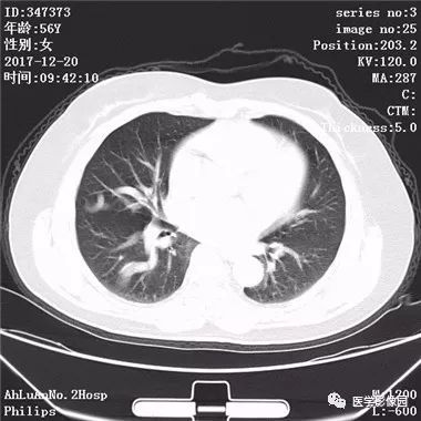 【病例】肺动静脉瘘1例CT影像表现 【病例】肺动静脉瘘1例CT影像表现