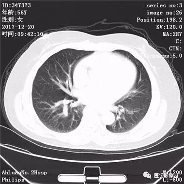 【病例】肺动静脉瘘1例CT影像表现 【病例】肺动静脉瘘1例CT影像表现
