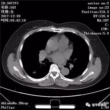 【病例】肺动静脉瘘1例CT影像表现 【病例】肺动静脉瘘1例CT影像表现