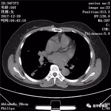 【病例】肺动静脉瘘1例CT影像表现 【病例】肺动静脉瘘1例CT影像表现