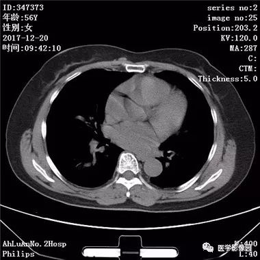 【病例】肺动静脉瘘1例CT影像表现 【病例】肺动静脉瘘1例CT影像表现