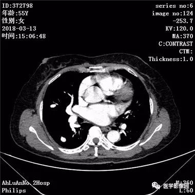 【病例】肺动静脉瘘1例CT影像表现 【病例】肺动静脉瘘1例CT影像表现