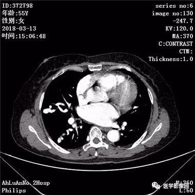 【病例】肺动静脉瘘1例CT影像表现 【病例】肺动静脉瘘1例CT影像表现