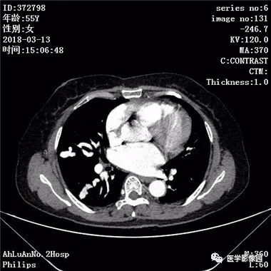 【病例】肺动静脉瘘1例CT影像表现 【病例】肺动静脉瘘1例CT影像表现