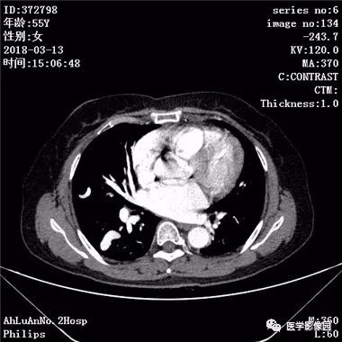 【病例】肺动静脉瘘1例CT影像表现 【病例】肺动静脉瘘1例CT影像表现