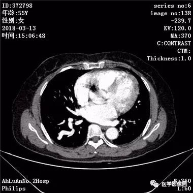 【病例】肺动静脉瘘1例CT影像表现 【病例】肺动静脉瘘1例CT影像表现