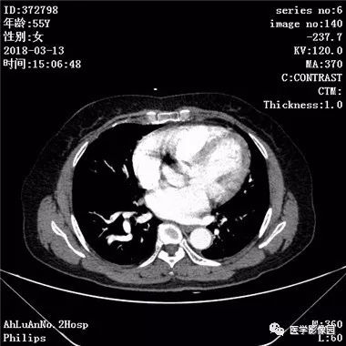 【病例】肺动静脉瘘1例CT影像表现 【病例】肺动静脉瘘1例CT影像表现