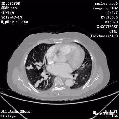 【病例】肺动静脉瘘1例CT影像表现 【病例】肺动静脉瘘1例CT影像表现