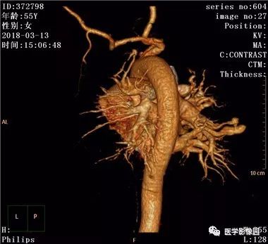 【病例】肺动静脉瘘1例CT影像表现 【病例】肺动静脉瘘1例CT影像表现