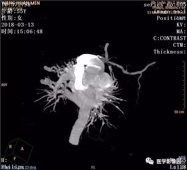 【病例】肺动静脉瘘1例CT影像表现 【病例】肺动静脉瘘1例CT影像表现