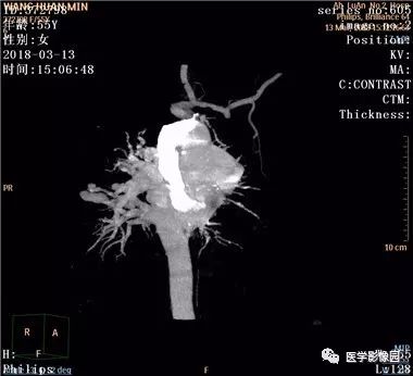 【病例】肺动静脉瘘1例CT影像表现 【病例】肺动静脉瘘1例CT影像表现