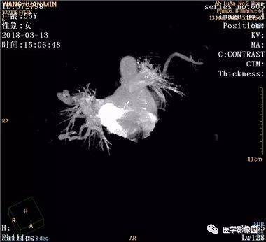 【病例】肺动静脉瘘1例CT影像表现 【病例】肺动静脉瘘1例CT影像表现