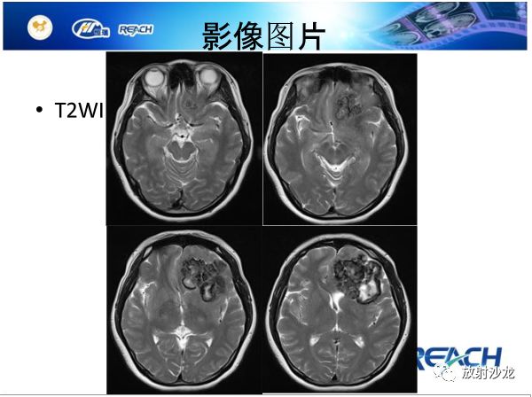 【病例】颅内软骨瘤1例MR影像表现