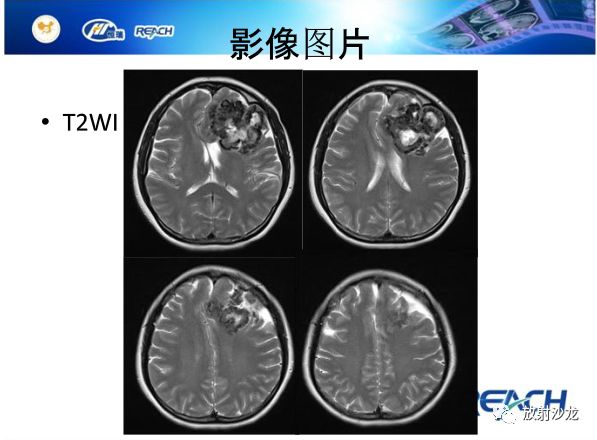 【病例】颅内软骨瘤1例MR影像表现
