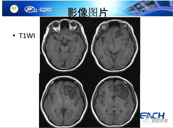 【病例】颅内软骨瘤1例MR影像表现