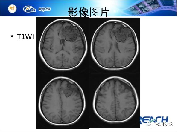 【病例】颅内软骨瘤1例MR影像表现