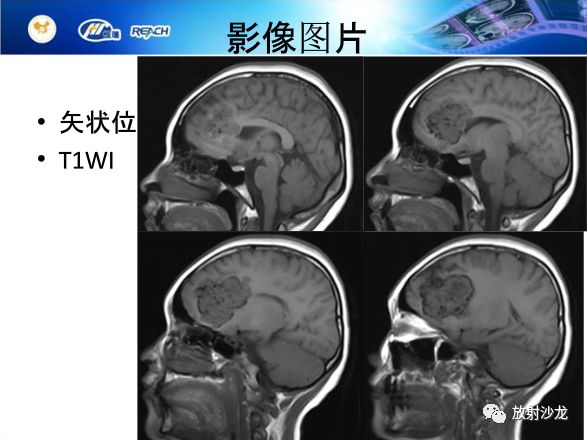 【病例】颅内软骨瘤1例MR影像表现