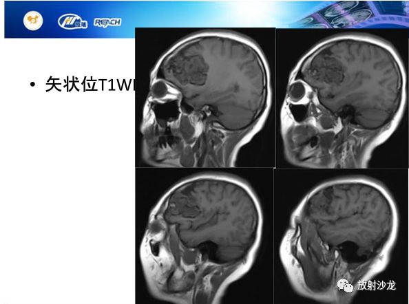 【病例】颅内软骨瘤1例MR影像表现