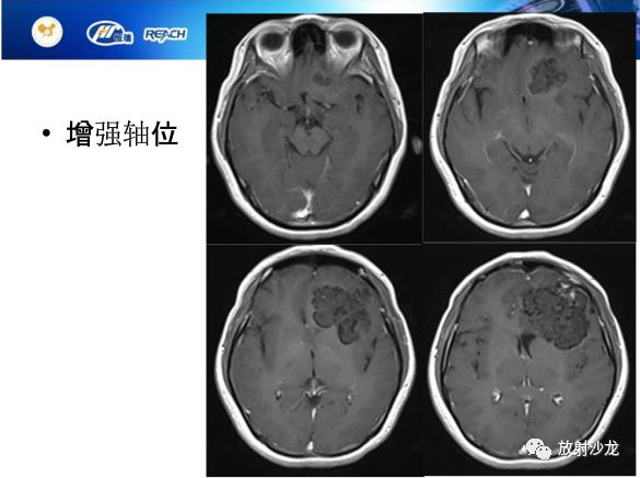 【病例】颅内软骨瘤1例MR影像表现