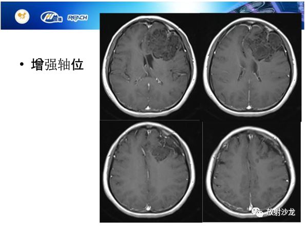 【病例】颅内软骨瘤1例MR影像表现