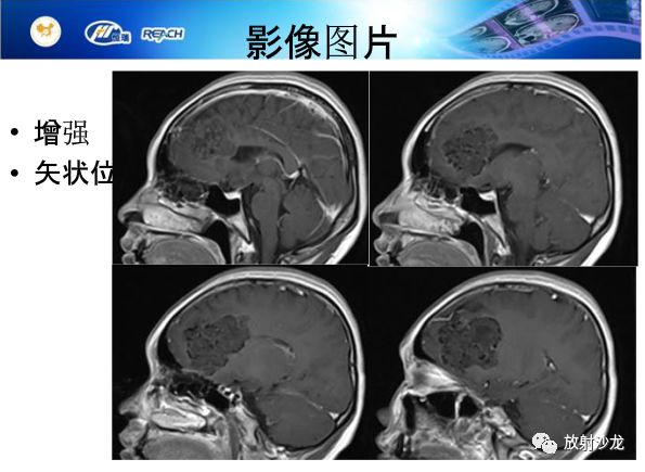 【病例】颅内软骨瘤1例MR影像表现