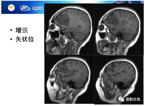 【病例】颅内软骨瘤1例MR影像表现