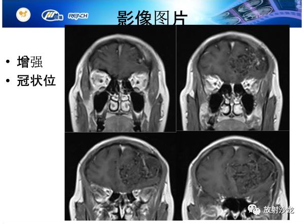 【病例】颅内软骨瘤1例MR影像表现