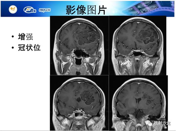 【病例】颅内软骨瘤1例MR影像表现