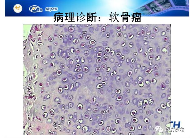 【病例】颅内软骨瘤1例MR影像表现