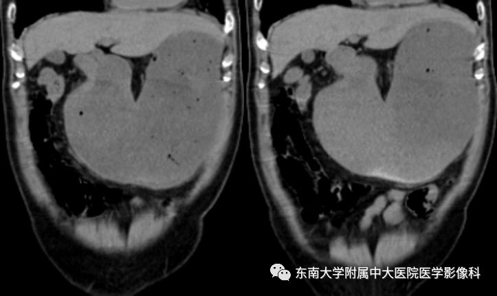 【病例】胃癌1例影像诊断与分期