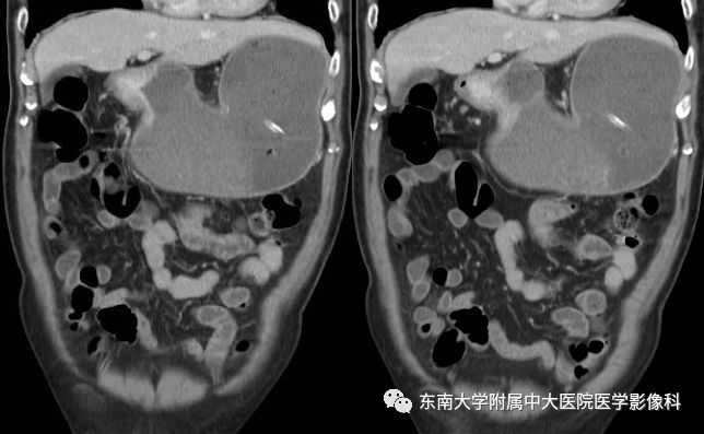 【病例】胃癌1例影像诊断与分期