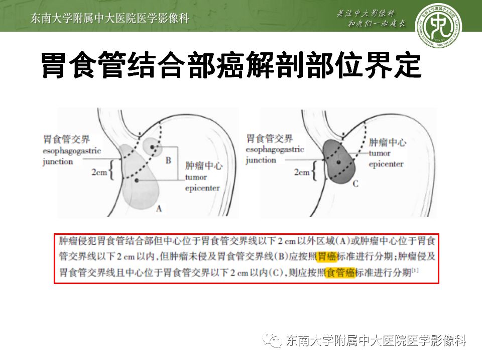 【病例】胃癌1例影像诊断与分期
