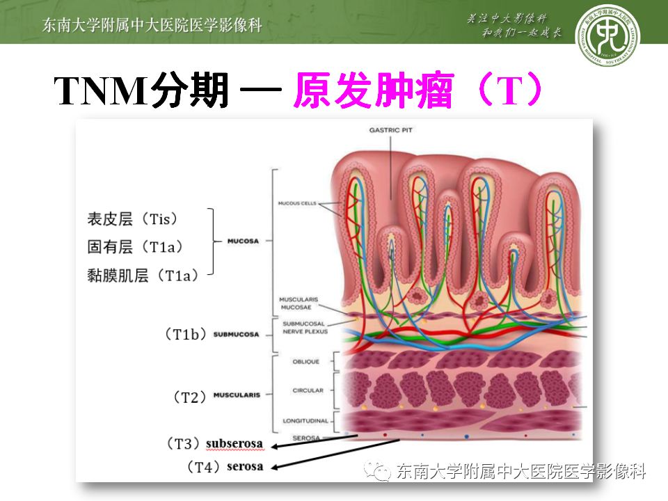 【病例】胃癌1例影像诊断与分期