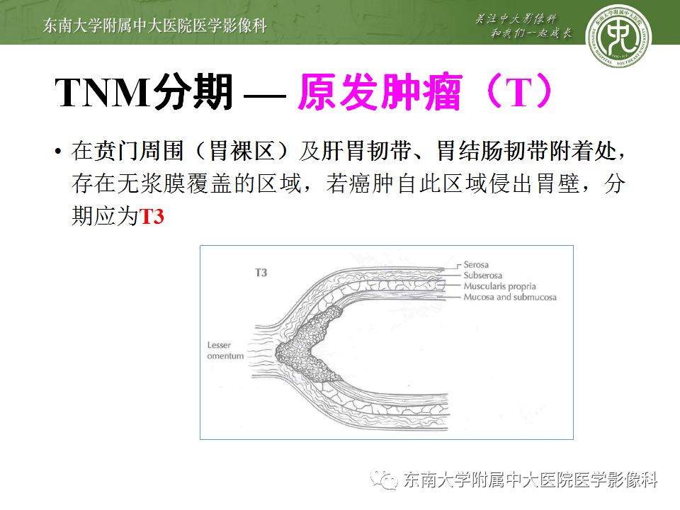 【病例】胃癌1例影像诊断与分期