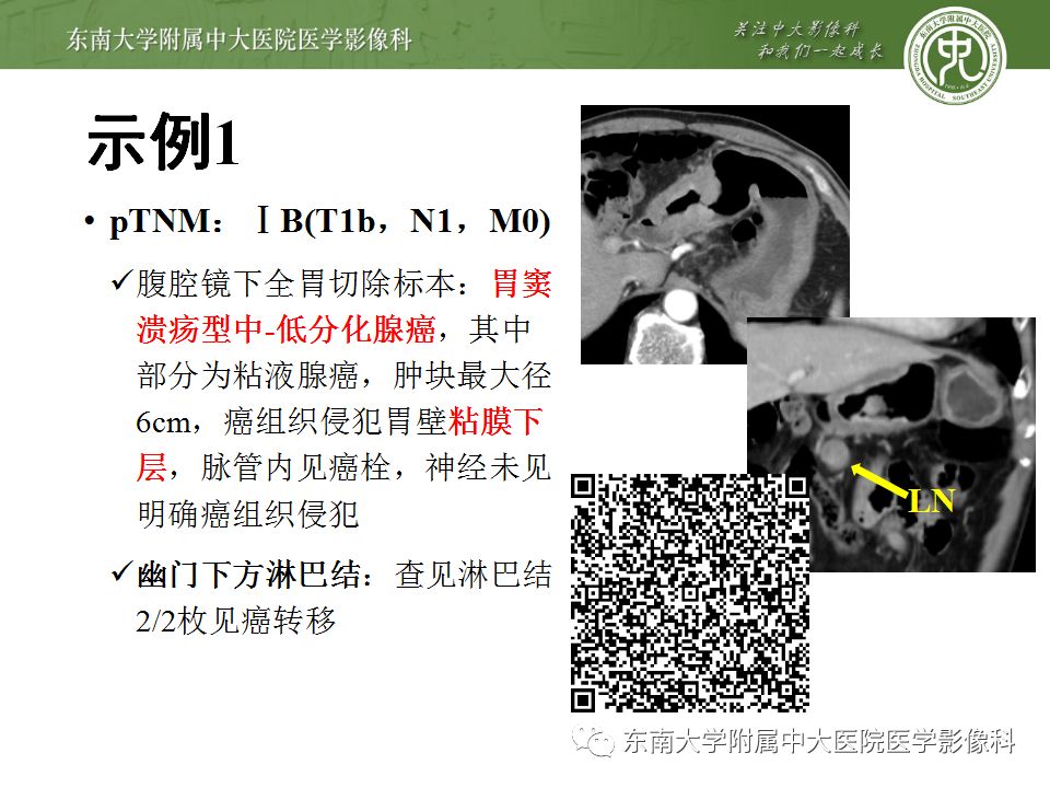 【病例】胃癌1例影像诊断与分期