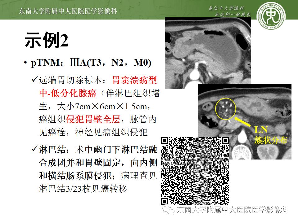 【病例】胃癌1例影像诊断与分期