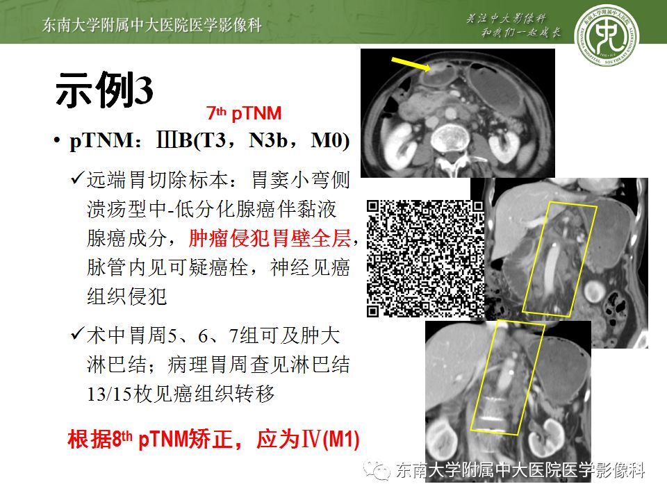 【病例】胃癌1例影像诊断与分期