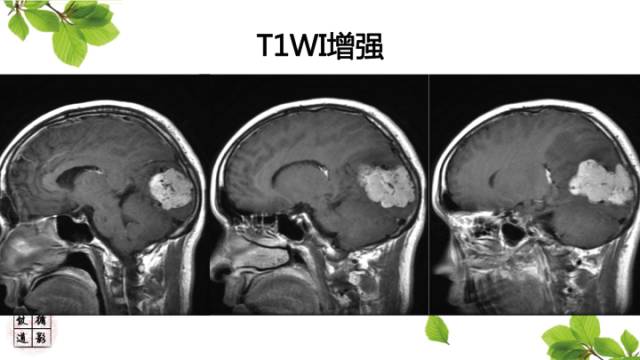 【病例】颅内孤立性纤维瘤/血管外皮瘤1例MR影像诊断