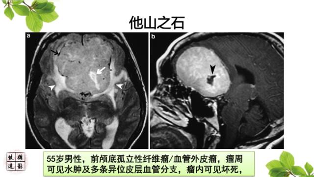 【病例】颅内孤立性纤维瘤/血管外皮瘤1例MR影像诊断