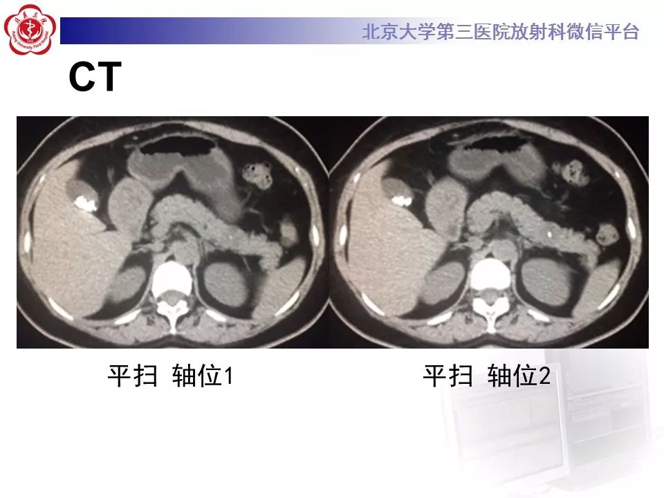 【病例】胰腺实性假乳头状瘤1例CT及MR影像诊断