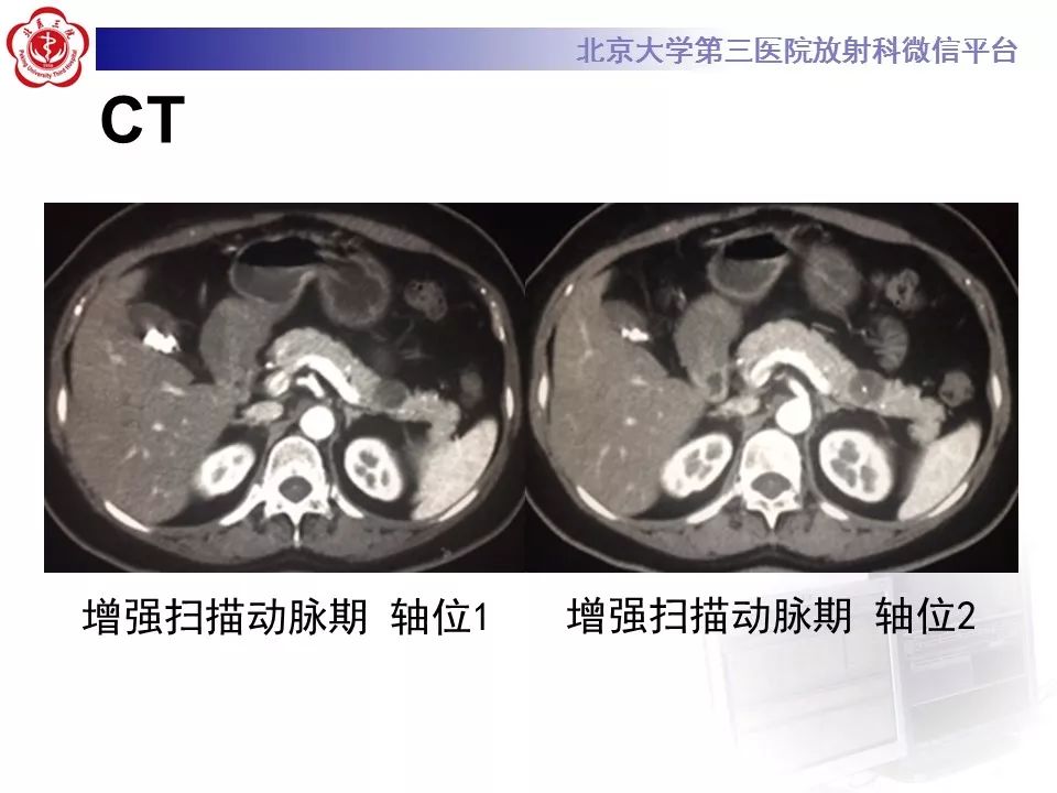 【病例】胰腺实性假乳头状瘤1例CT及MR影像诊断