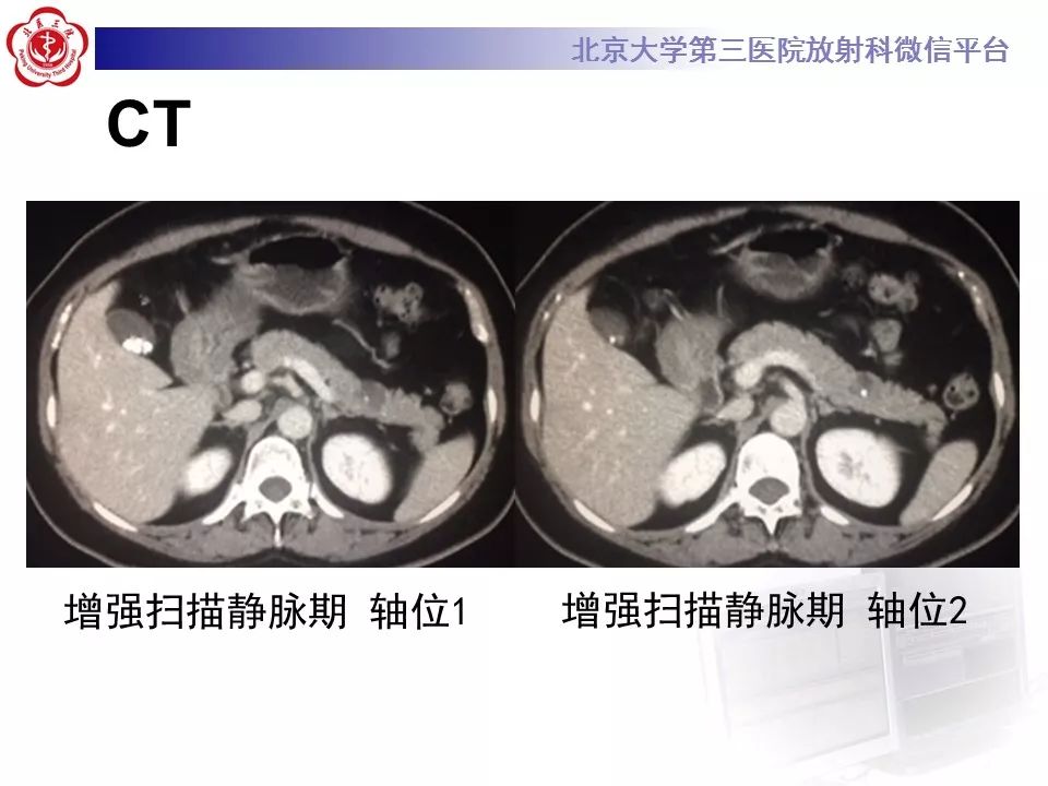 【病例】胰腺实性假乳头状瘤1例CT及MR影像诊断