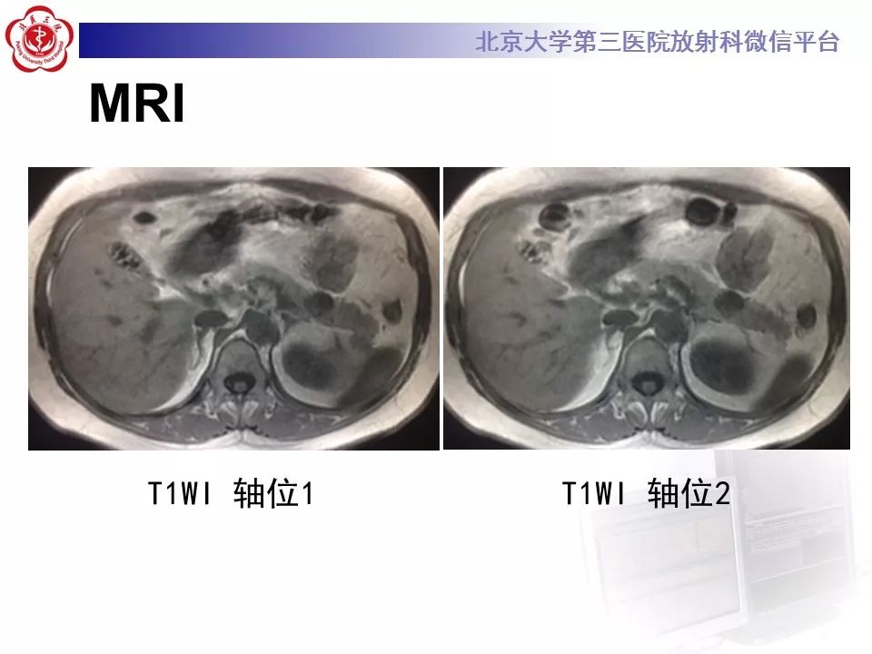 【病例】胰腺实性假乳头状瘤1例CT及MR影像诊断