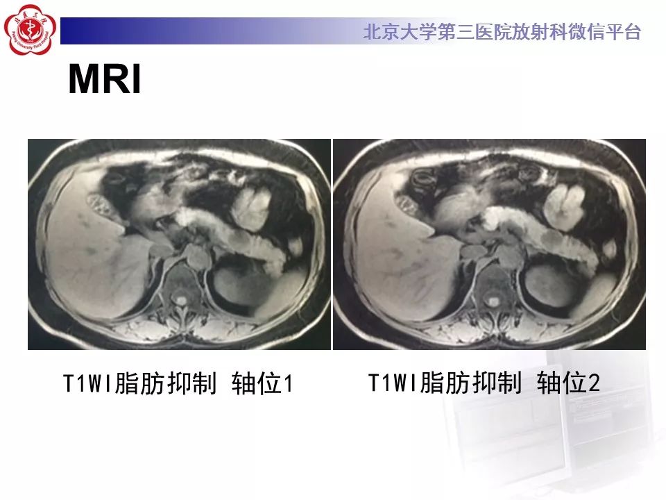 【病例】胰腺实性假乳头状瘤1例CT及MR影像诊断